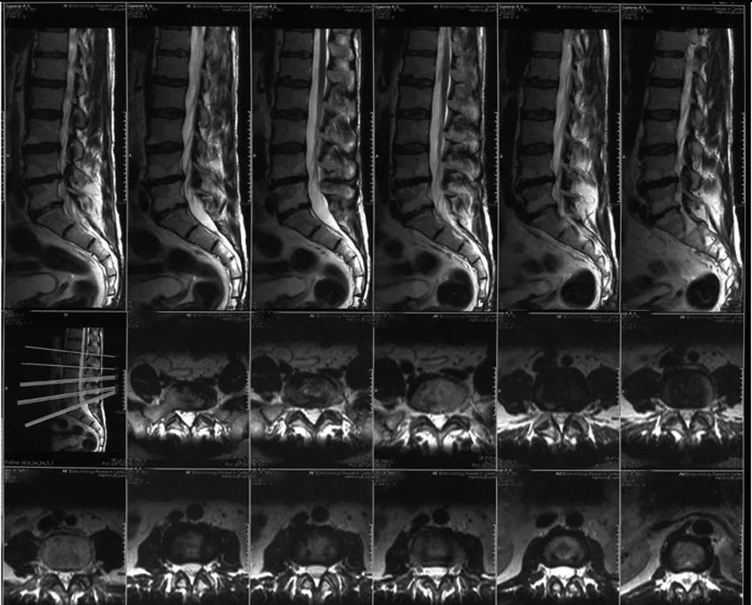 МР-томограммы позвоночника, сагиттальные и аксиальные срезы
